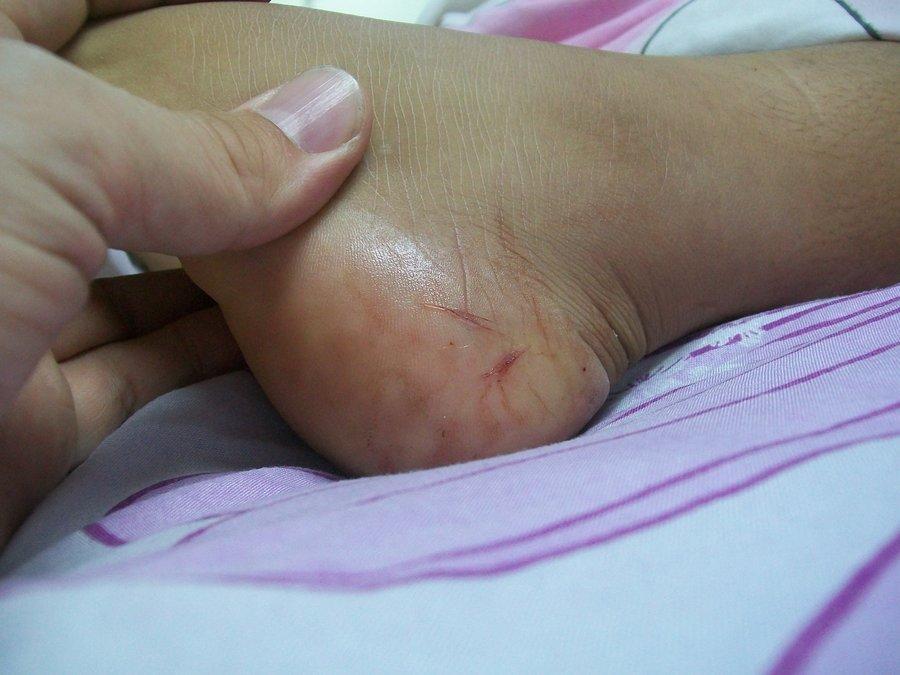 نکته بهداشتی: کمک های اولیه مارگزیدگی نکته بهداشتی: یاری های اولیه مارگزیدگی