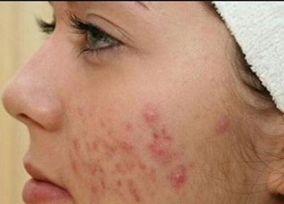 جای جوش را چگونه از بین ببریم؟