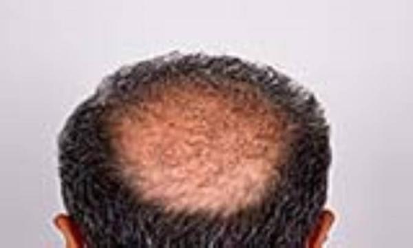 علل آلوپسی اسکار علل آلوپسی اسکار