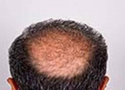 علل آلوپسی اسکار